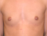 Patient # 36010 Before Photo # 1