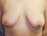 Patient # 54943 Before Photo # 1