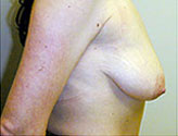 Patient # 54943 Before Photo # 3