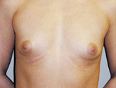 Patient # 48449 Before Photo # 1