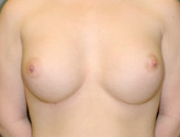 Patient # 82364 After Photo # 2