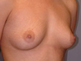 Patient # 15427 Before Photo # 1