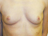 Patient # 89786 Before Photo # 1