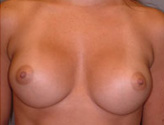 Patient # 81127 After Photo # 2