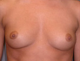Patient # 81127 Before Photo # 1