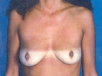 Patient # 11673 Before Photo # 1