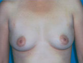 Patient # 66419 Before Photo # 1
