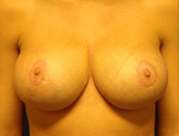 Patient # 54841 After Photo # 2