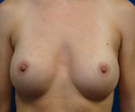 Patient # 68398 After Photo # 2