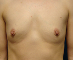 Patient # 68398 Before Photo # 1