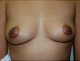 Patient # 98049 Before Photo # 1