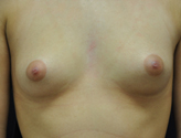 Patient # 28101 Before Photo # 1
