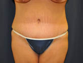 Patient # 52531 After Photo # 2