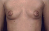 Patient # 25464 Before Photo # 1