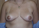 Patient # 52121 After Photo # 2
