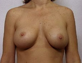 Patient # 87589 After Photo # 2