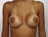 Patient # 90283 After Photo # 2