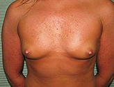 Patient # 56369 Before Photo # 1