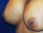 Patient # 81990 After Photo # 4