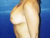 Patient # 81990 After Photo # 6