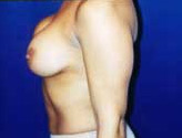 Patient # 81990 Before Photo # 5