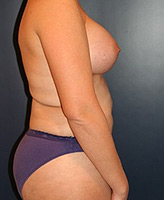 Patient # 59533 After Photo # 2