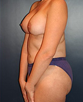 Patient # 59533 After Photo # 4