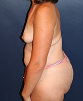 Patient # 59533 Before Photo # 3