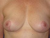 Patient # 58285 After Photo # 2