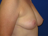 Patient # 58285 After Photo # 4