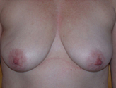 Patient # 58285 Before Photo # 1