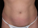Patient # 40704 Before Photo # 1