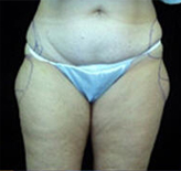 Patient # 18906 Before Photo # 1