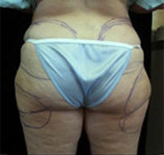 Patient # 18906 Before Photo # 3