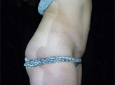 Patient # 17112 After Photo # 4