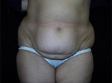 Patient # 17112 Before Photo # 1