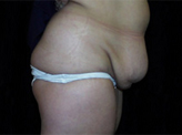 Patient # 17112 Before Photo # 3