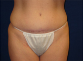 Patient # 57363 After Photo # 2