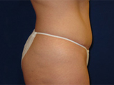 Patient # 57363 After Photo # 4