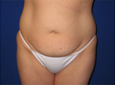 Patient # 57363 Before Photo # 1