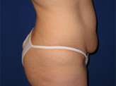 Patient # 57363 Before Photo # 3