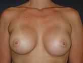 Patient # 91456 After Photo # 2