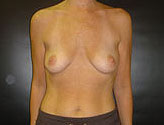Patient # 62600 Before Photo # 1