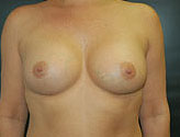 Patient # 86708 After Photo # 2