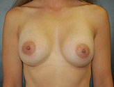 Patient # 30176 After Photo # 2