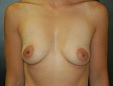 Patient # 30176 Before Photo # 1