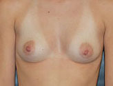 Patient # 19270 Before Photo # 1