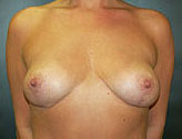 Patient # 40082 After Photo # 2