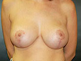 Patient # 26862 After Photo # 2