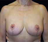 Patient # 47276 After Photo # 2